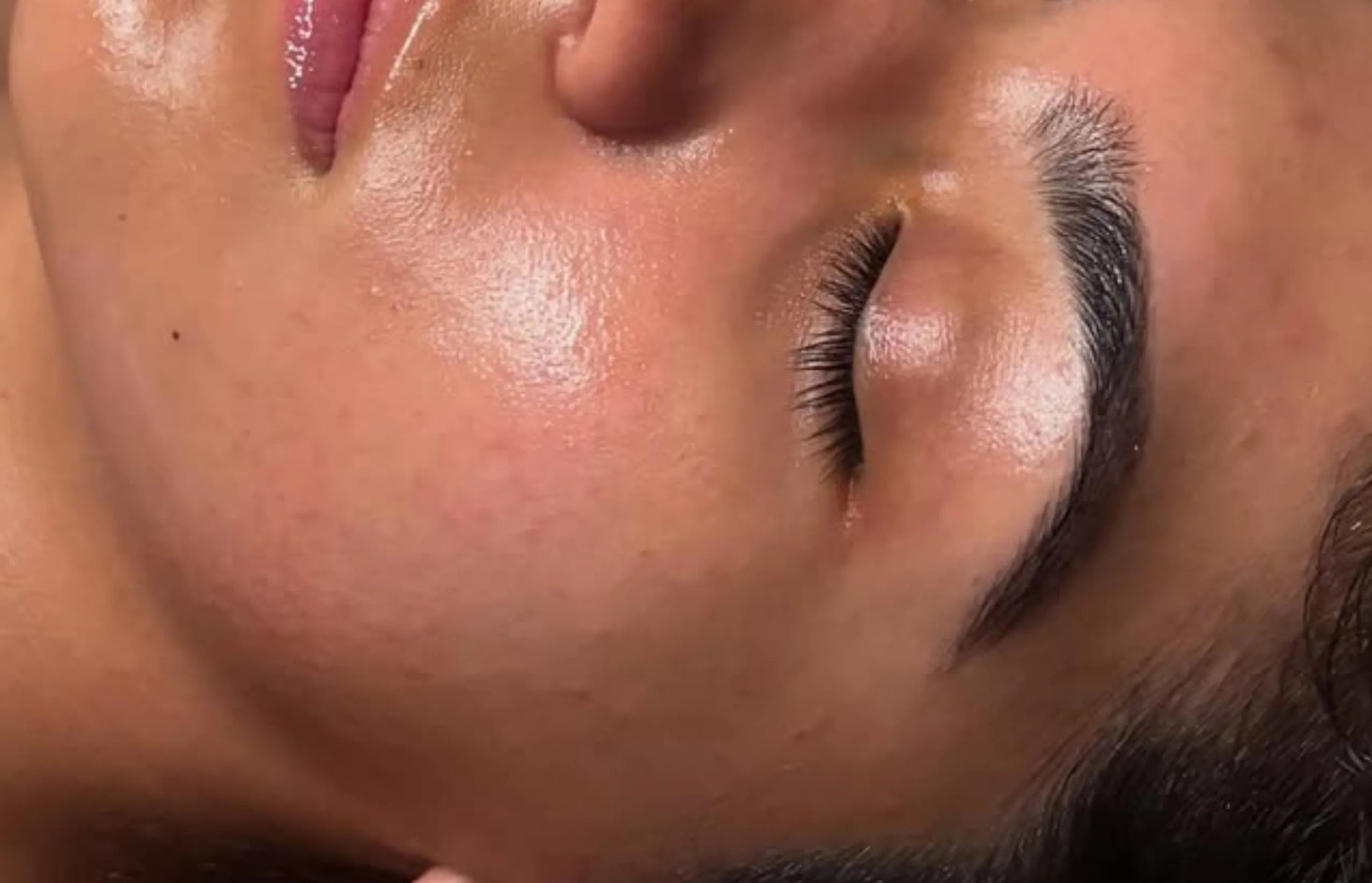 LED facial for acne