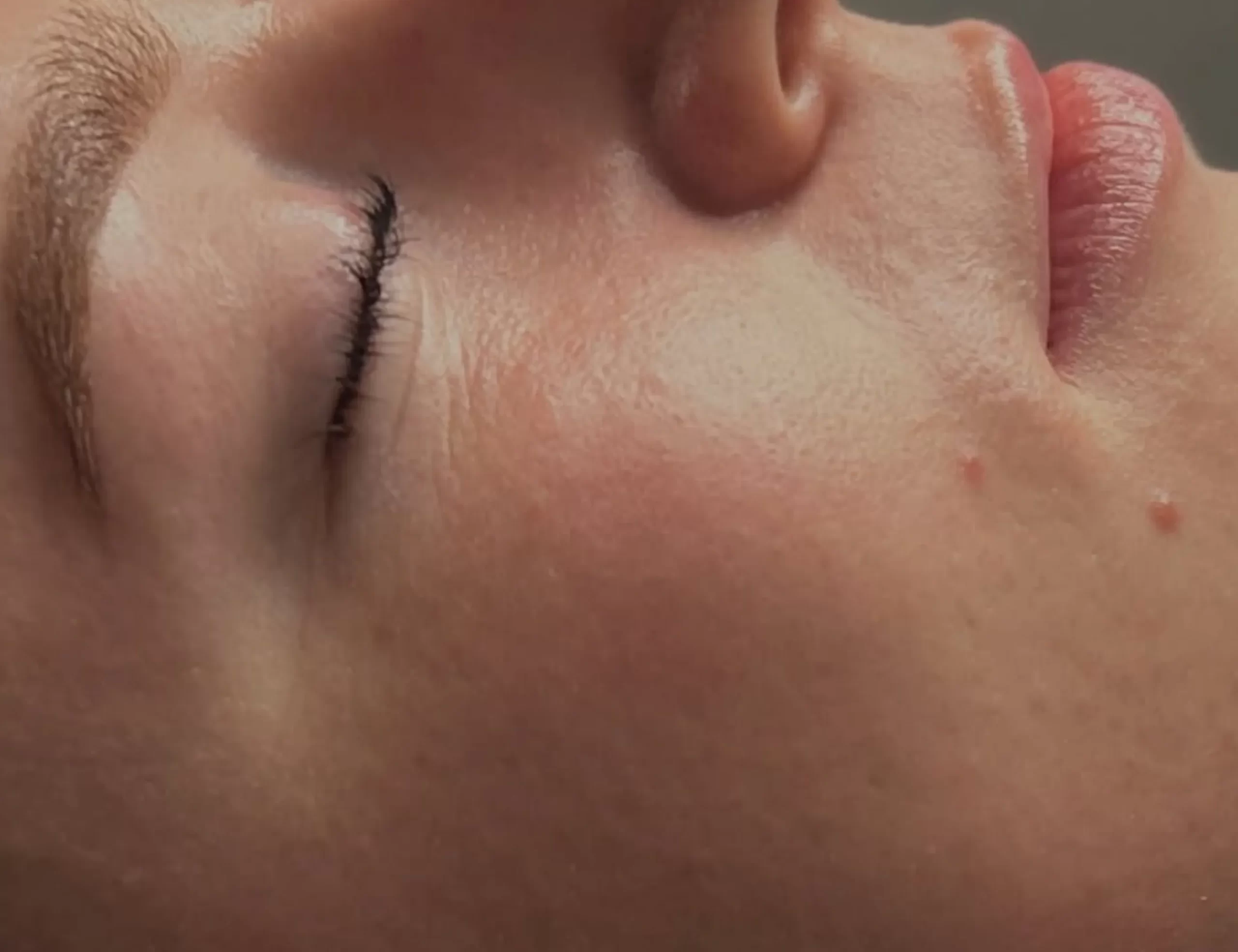 dermaplaning facial benefits