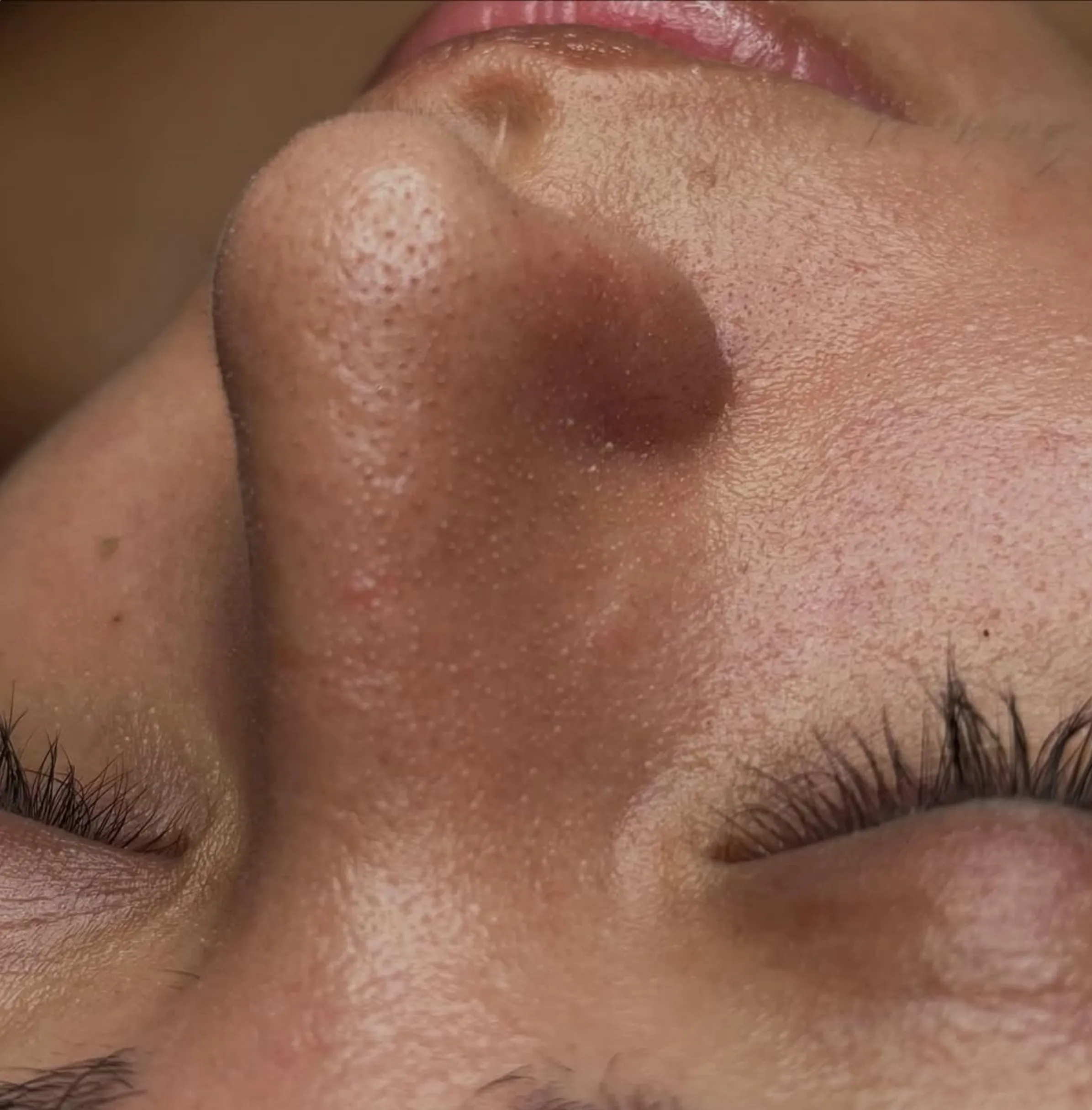 facial for pigmentation and acne