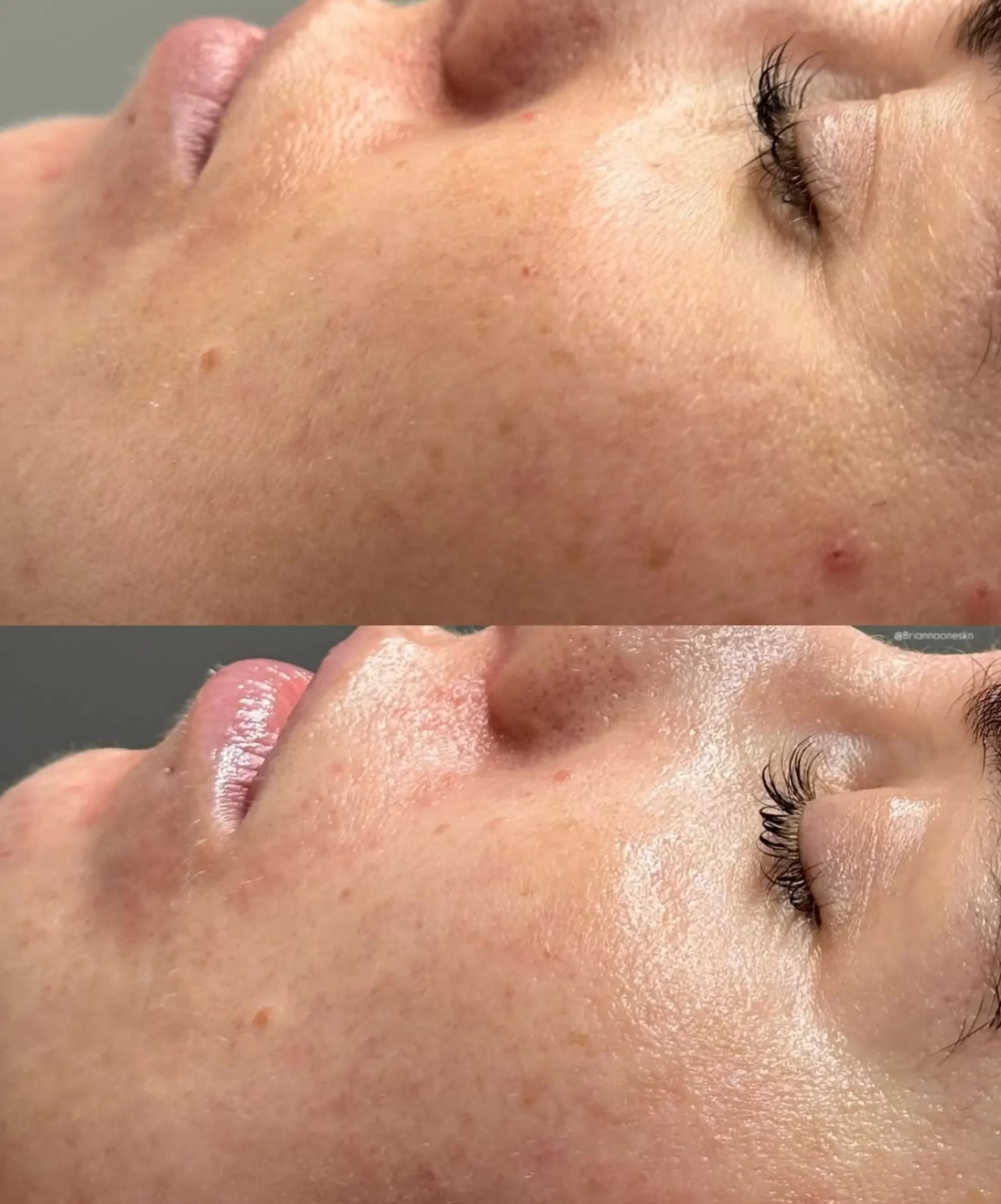 microneedling vs chemical peel
